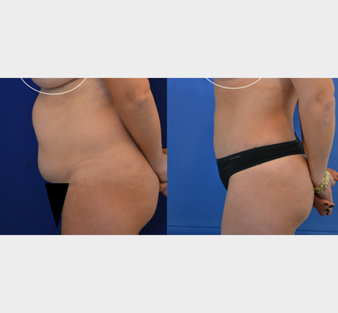 Tummy tuck before and after abdominal contour comparison