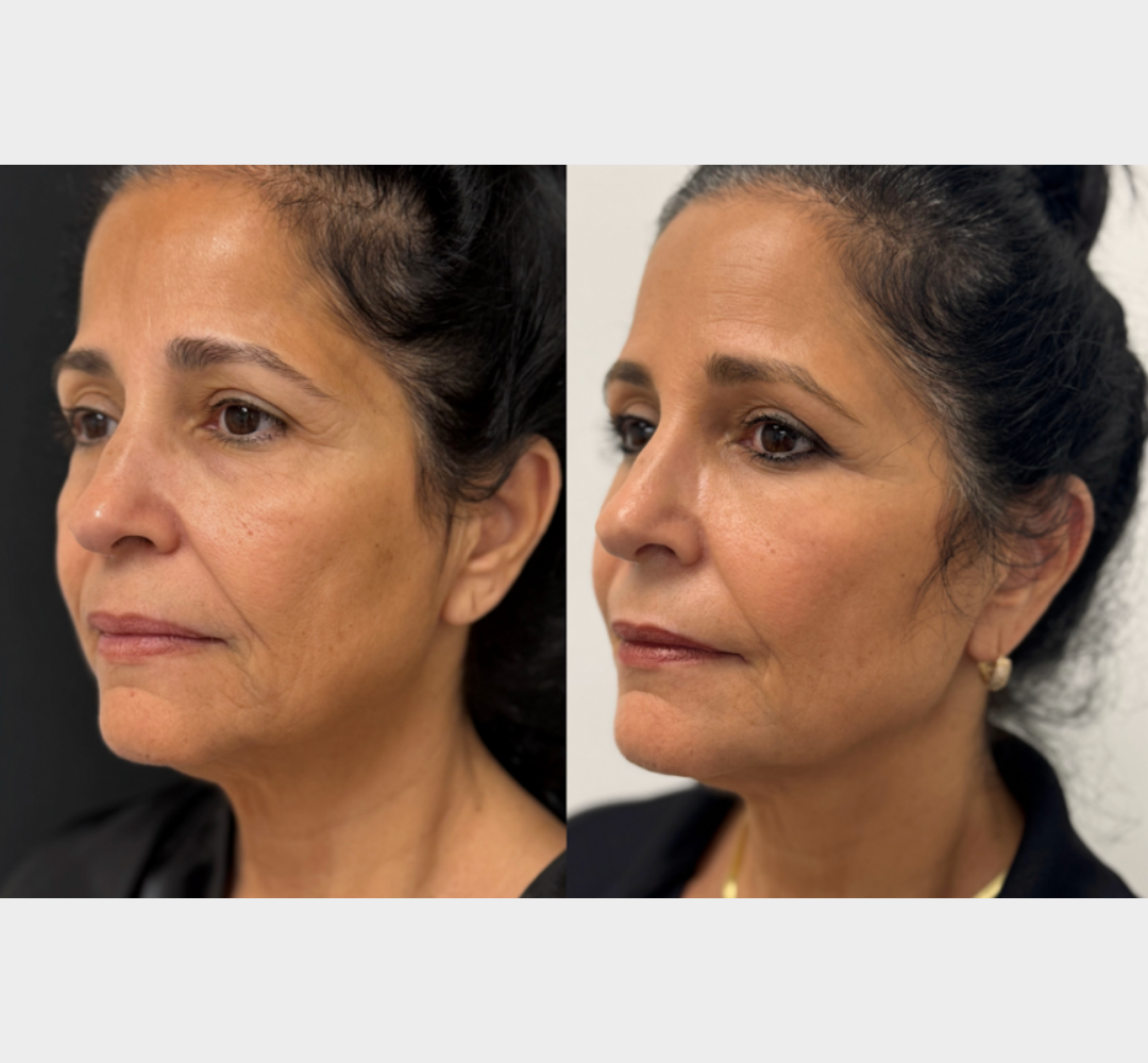 Attiva skin tightening before and after side profile facial comparison