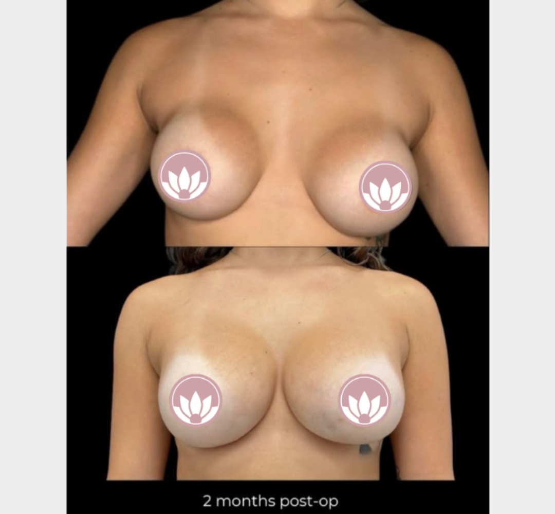 Female breast augmentation before and after front view comparison