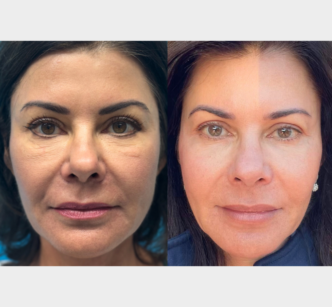 Attiva facial skin tightening treatment before and after comparison