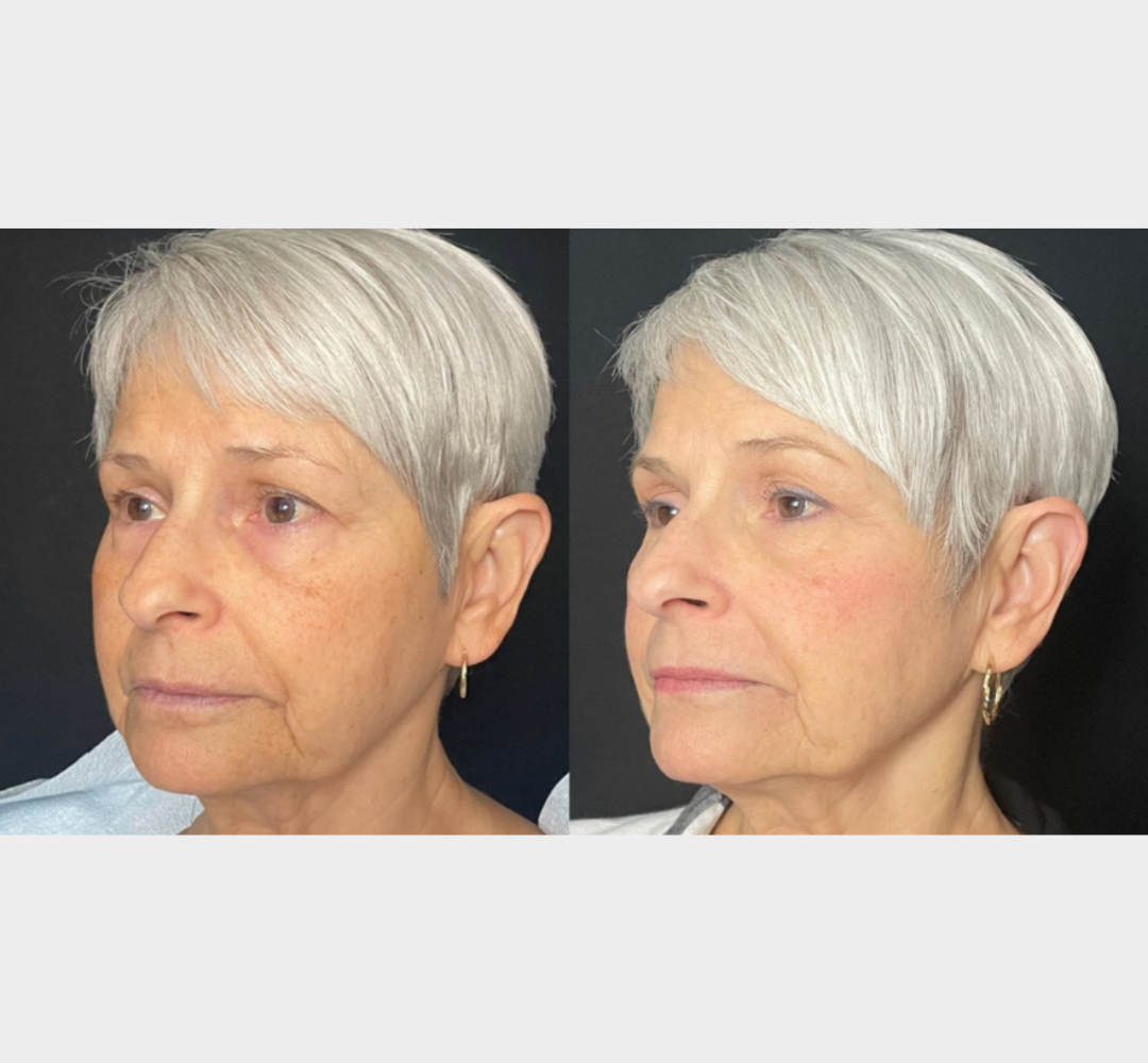 Attiva skin tightening before and after facial skin comparison