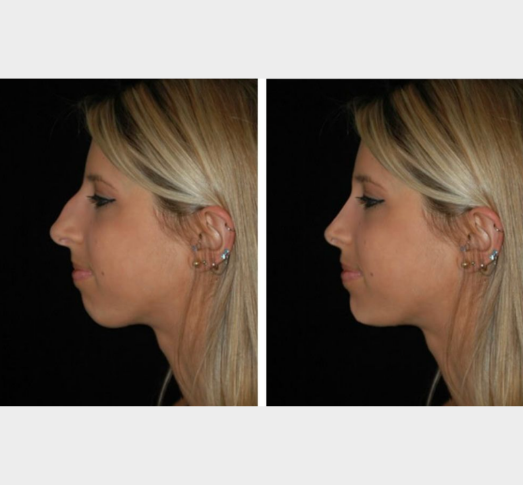 Female rhinoplasty before and after side profile comparison