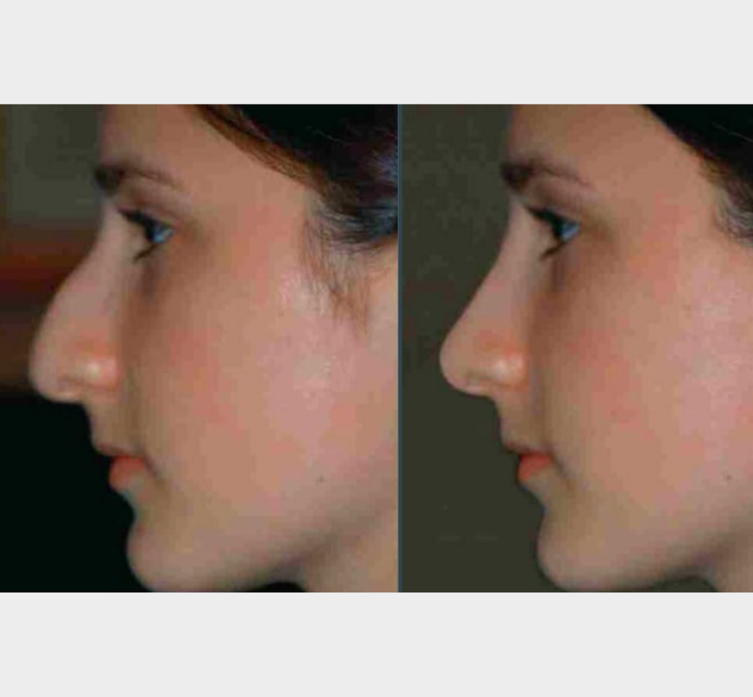 Rhinoplasty before and after nose profile comparison