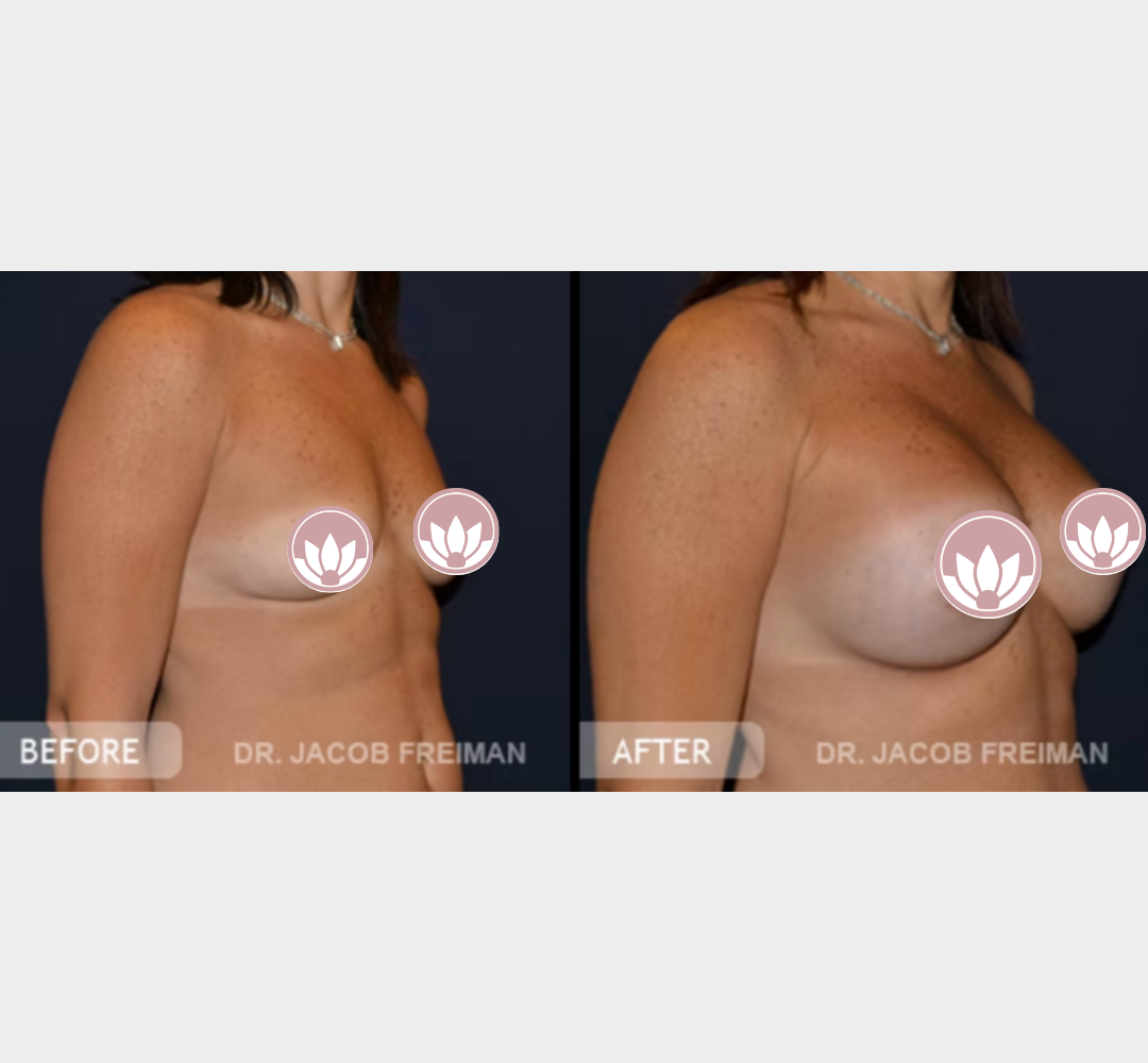 Breast augmentation before and after comparison of breast volume and shape