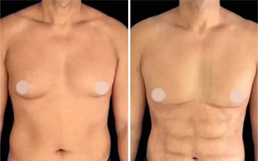 Ab Etching before and after