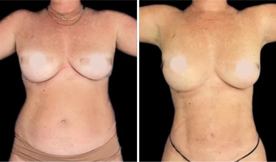 Ab Etching before and after