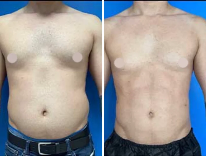Ab Etching before and after