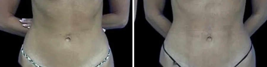 Ab Etching before and after