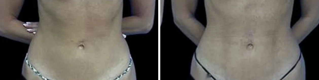 Ab Etching before and after