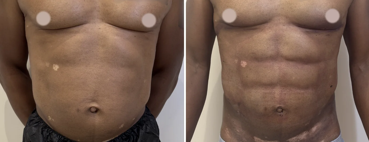 Ab Etching before and after