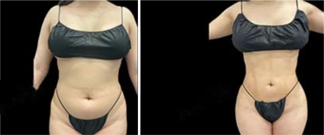 Ab Etching before and after