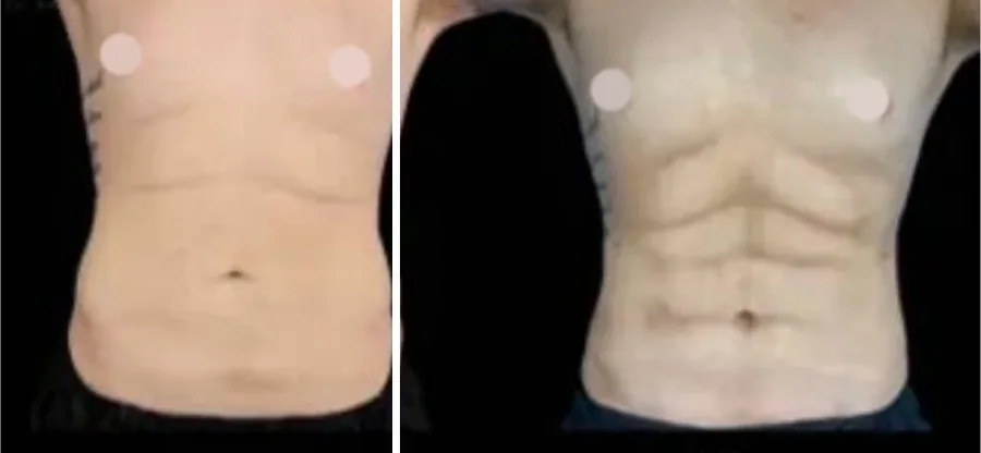 Ab Etching before and after