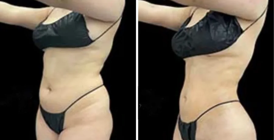 Ab Etching before and after