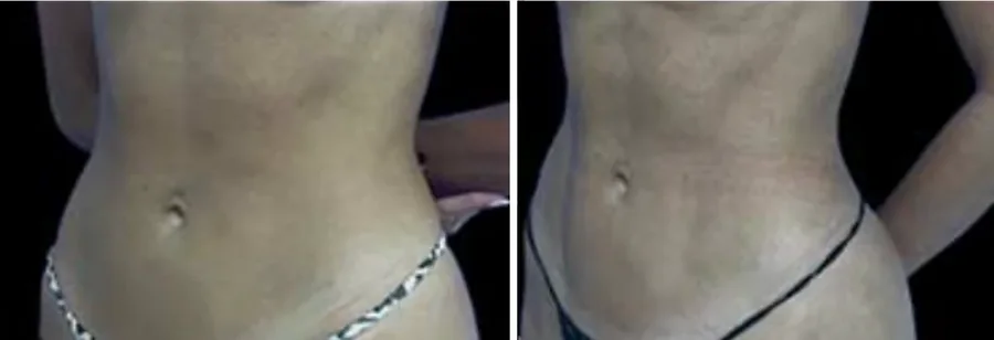 Ab Etching before and after