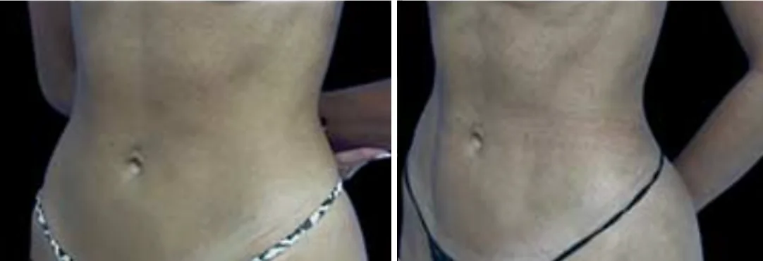 Ab Etching before and after