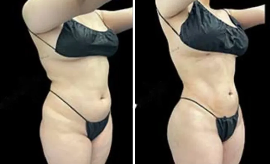 Ab Etching before and after