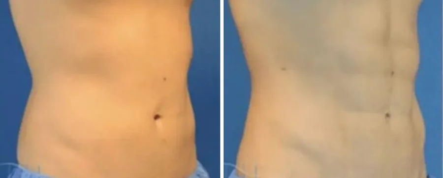 Ab Etching before and after