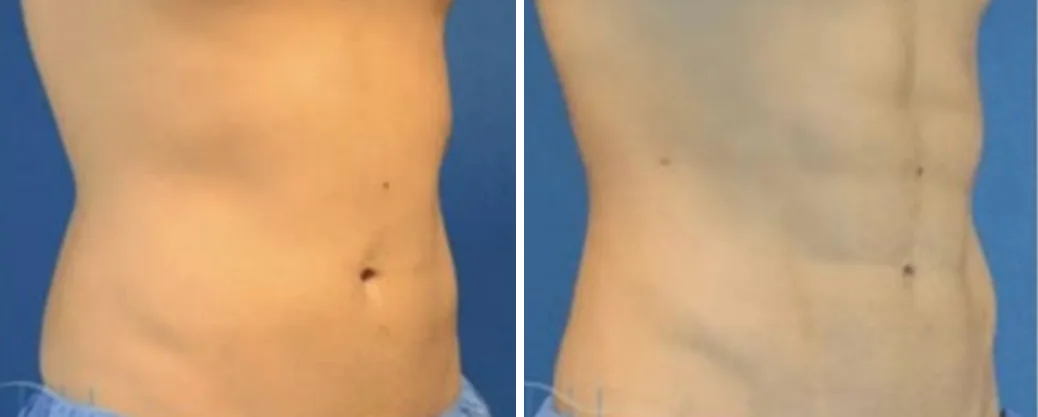 Ab Etching before and after