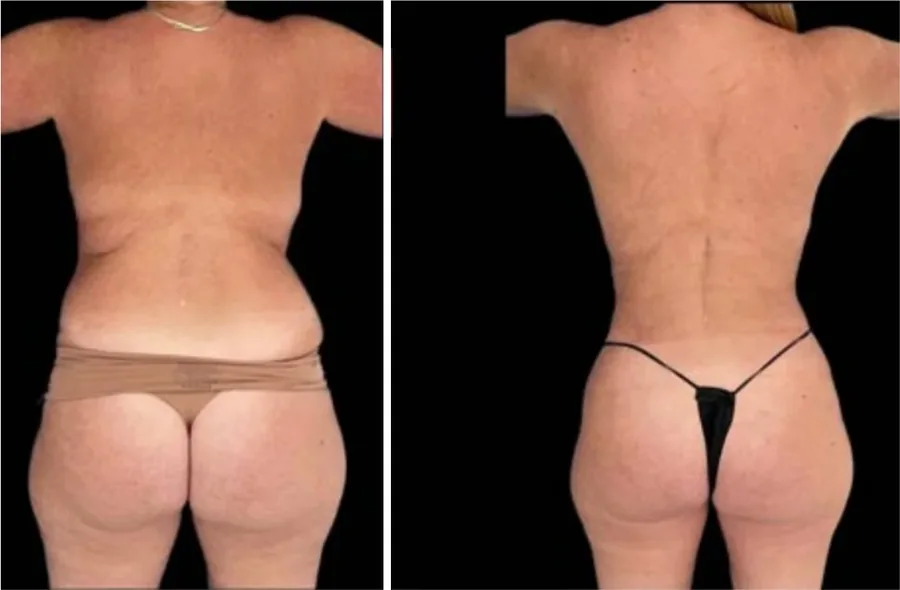 Ab Etching before and after
