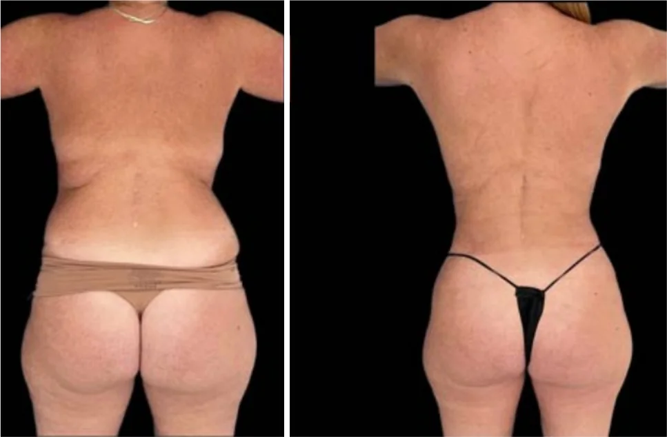 Ab Etching before and after