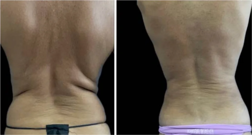 Ab Etching before and after