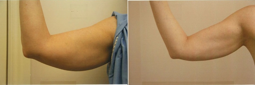Arm Lift before and after