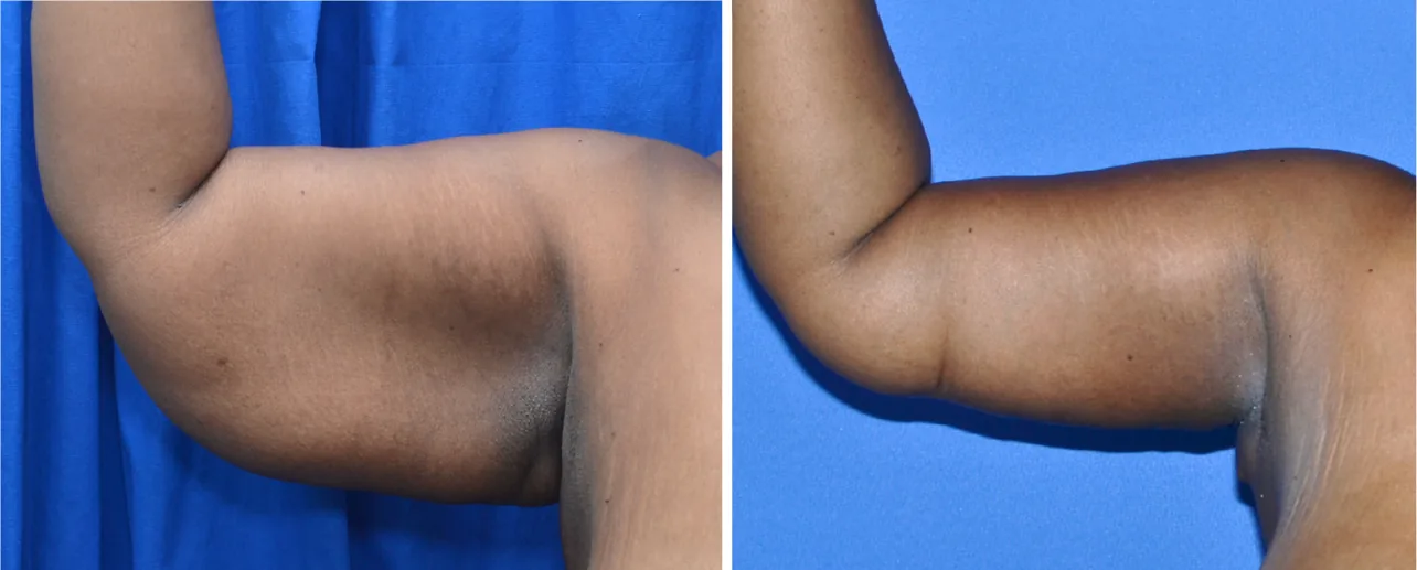 Arm Lift before and after