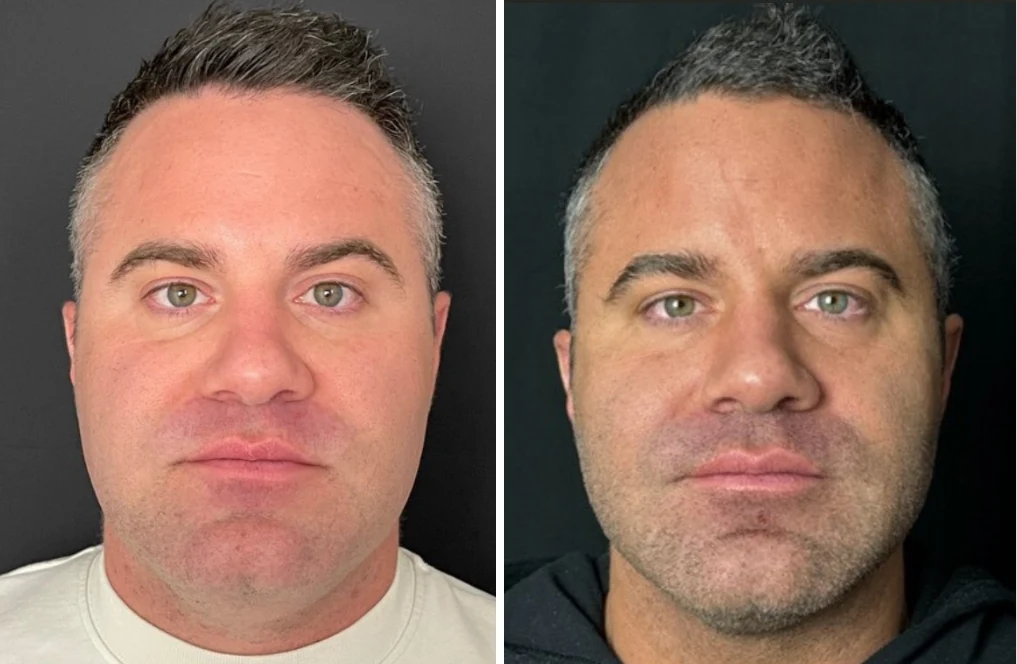 Attiva skin tightening before and after, men's face and jawline, front view, patient 4, enlarged