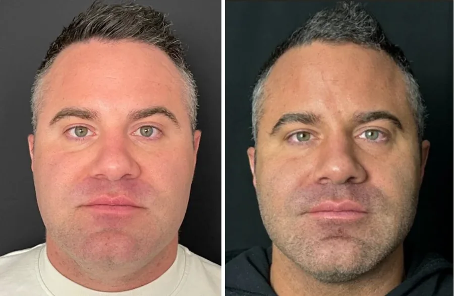 Attiva skin tightening before and after, men's face and jawline, front view, patient 4