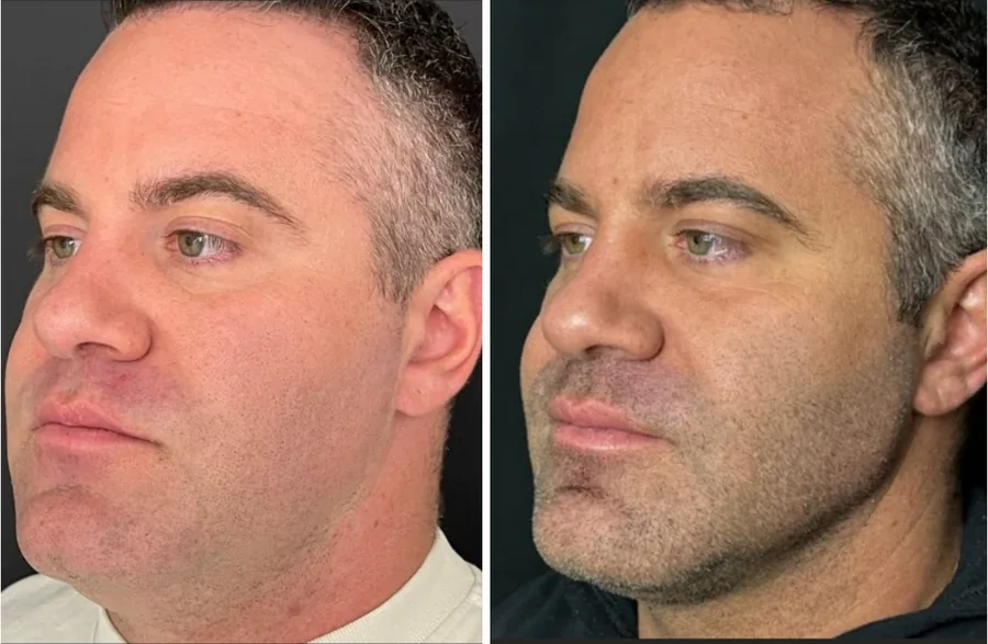 Attiva skin tightening before and after, men's jawline, left three-quarter view, patient 4