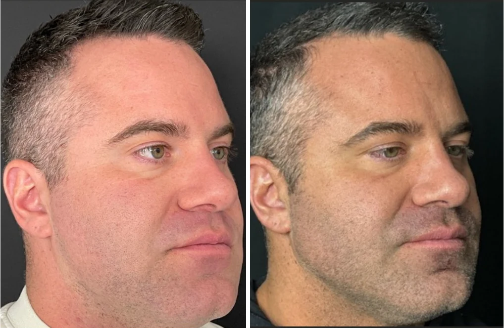 Attiva skin tightening before and after, men's jawline, right three-quarter view, patient 4, enlarged