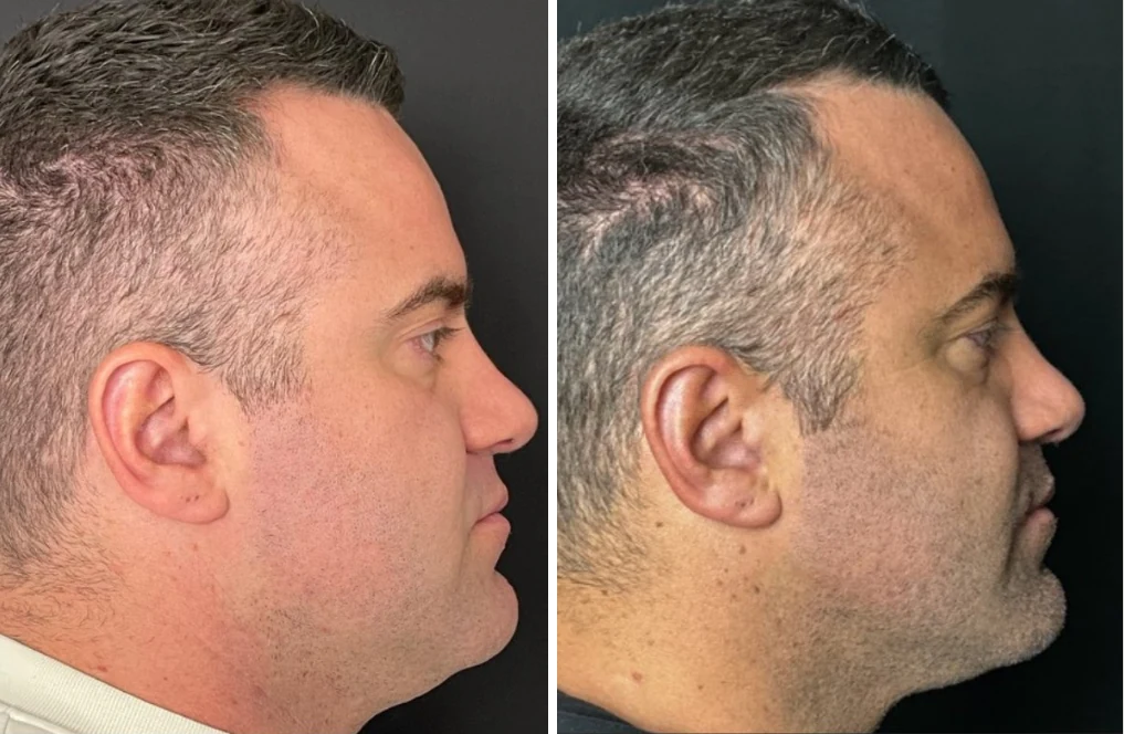 Attiva skin tightening before and after, men's jawline and neck, side profile, patient 4, enlarged