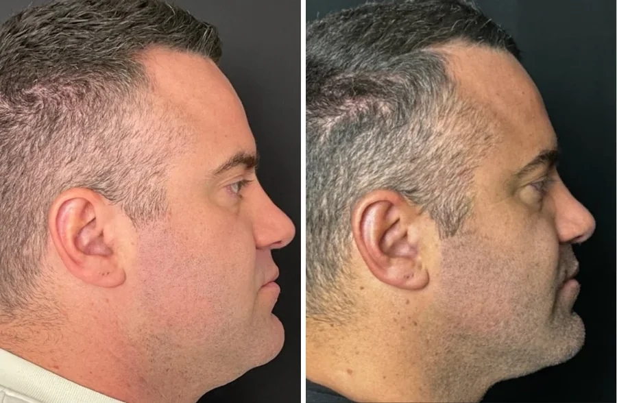 Attiva skin tightening before and after, men's jawline and neck, side profile, patient 4