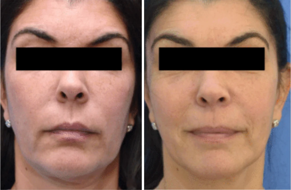 Attiva skin tightening before and after, lower face, front view, eyes covered for privacy, patient 9, enlarged