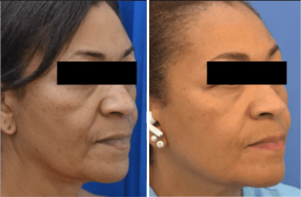 Attiva skin tightening before and after, lower face and jawline, three-quarter view, eyes covered for privacy, patient 10, enlarged