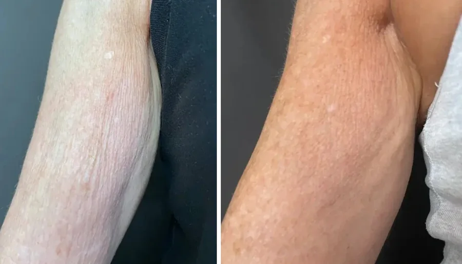Attiva skin tightening before and after, arm, crepey skin close-up, patient 11