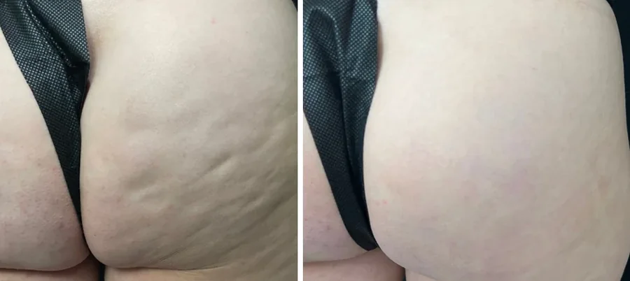 Attiva skin tightening before and after, buttock, cellulite and skin texture close-up, patient 12