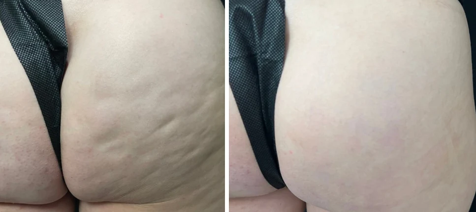 Attiva skin tightening before and after, buttock, cellulite and skin texture close-up, patient 12, enlarged