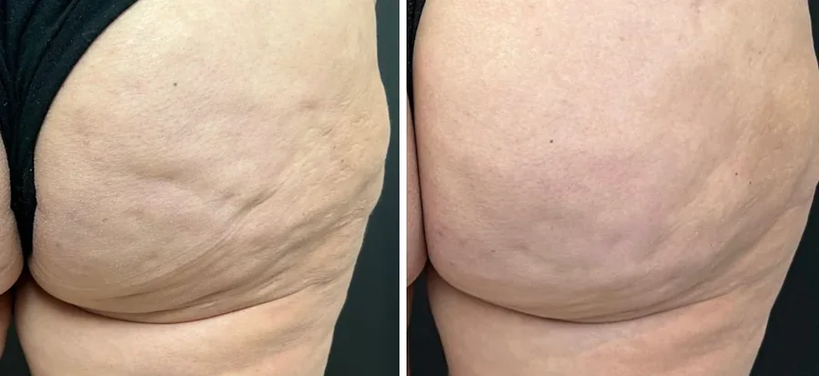 Attiva skin tightening before and after, buttock and thigh, skin laxity close-up, patient 13