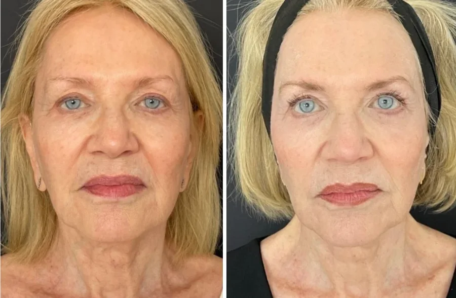 Attiva skin tightening before and after, face and neck, front view, patient 1