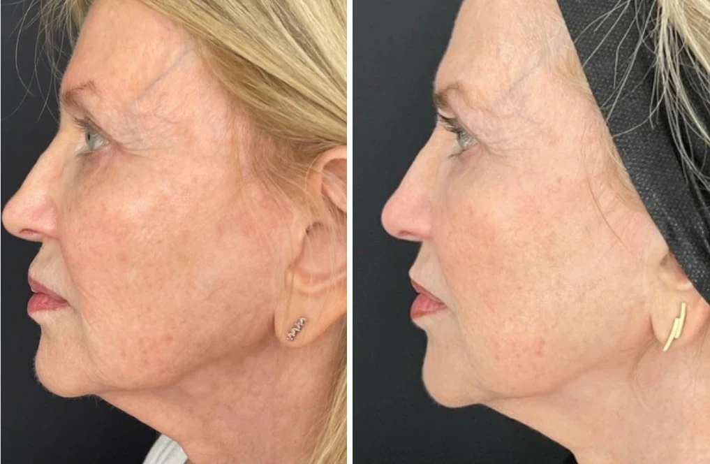 Attiva skin tightening before and after, jawline and neck, side profile, patient 1, enlarged