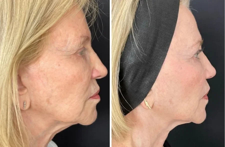 Attiva skin tightening before and after, jawline and neck, right side profile, patient 1