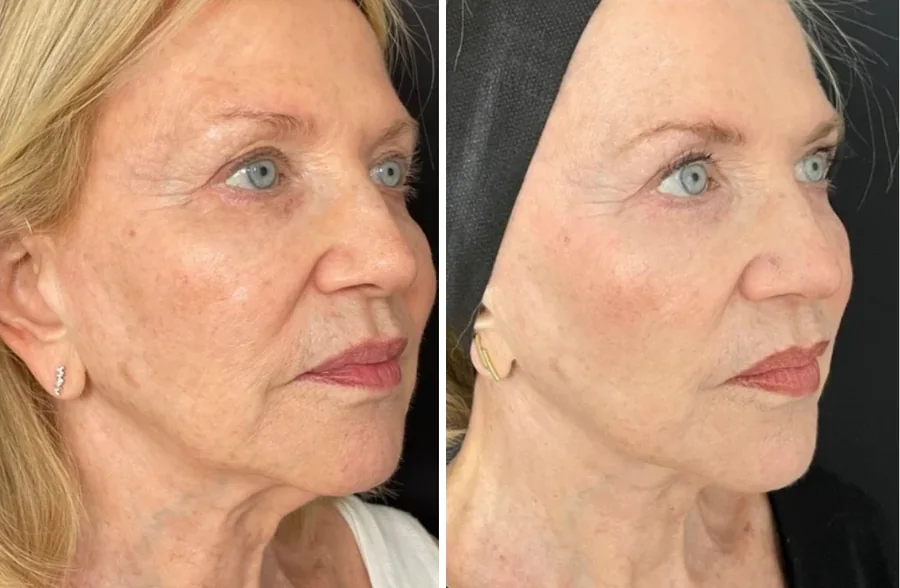 Attiva skin tightening before and after, cheek and jawline, close three-quarter view, patient 1