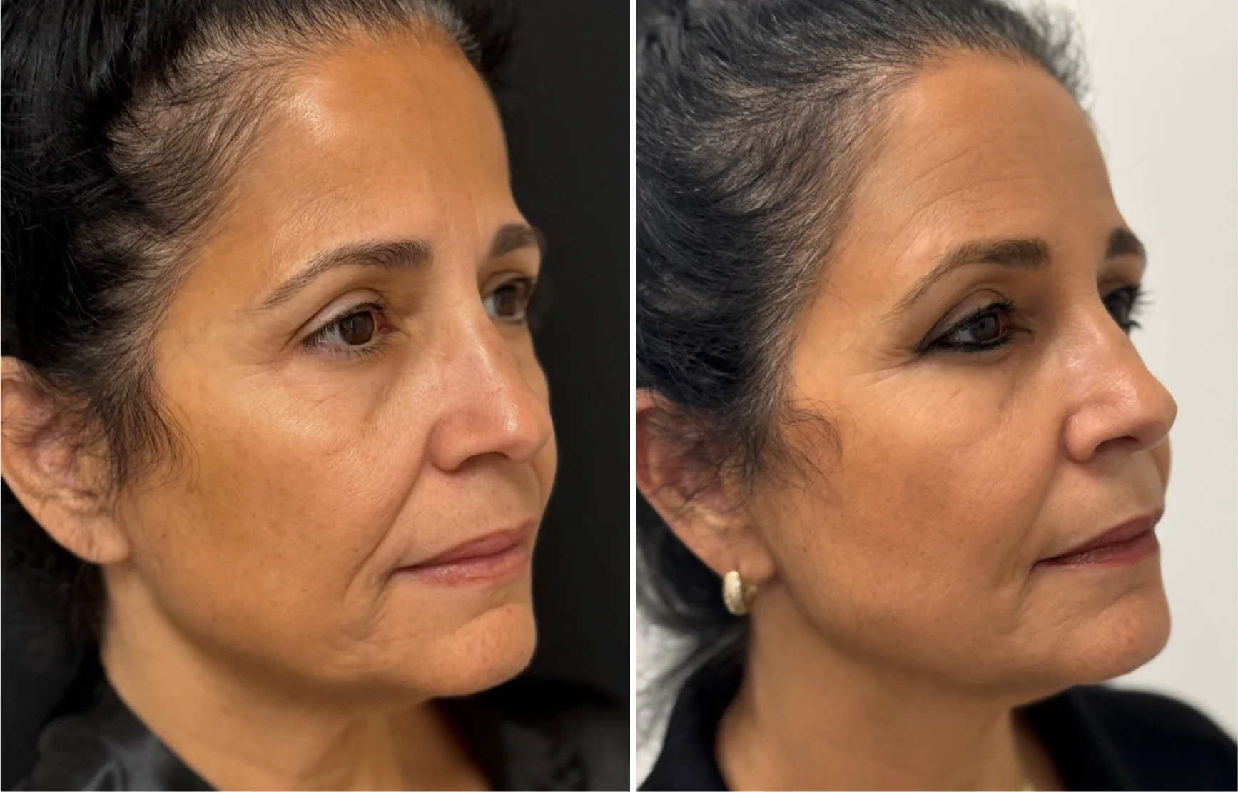 Attiva skin tightening before and after, jawline, left three-quarter view, patient 2, enlarged