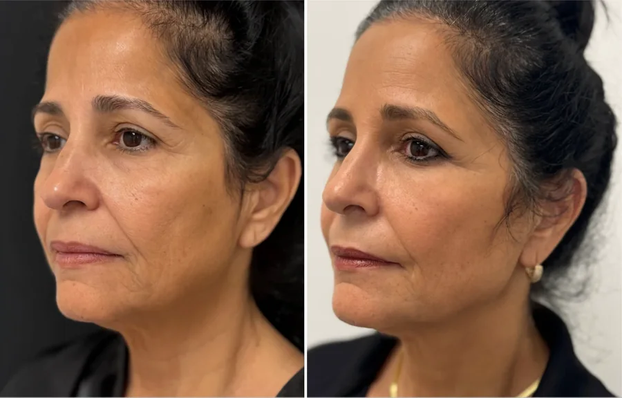 Attiva skin tightening before and after, jawline and neck, right three-quarter view, patient 2