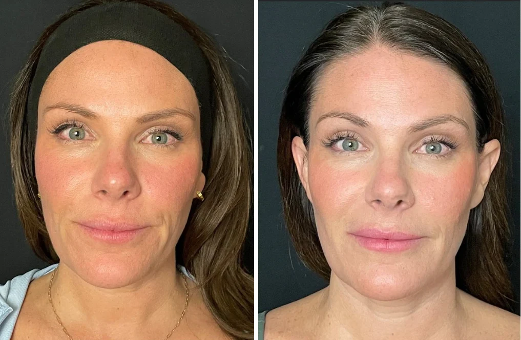 Attiva skin tightening before and after, face, front view, patient 3, enlarged