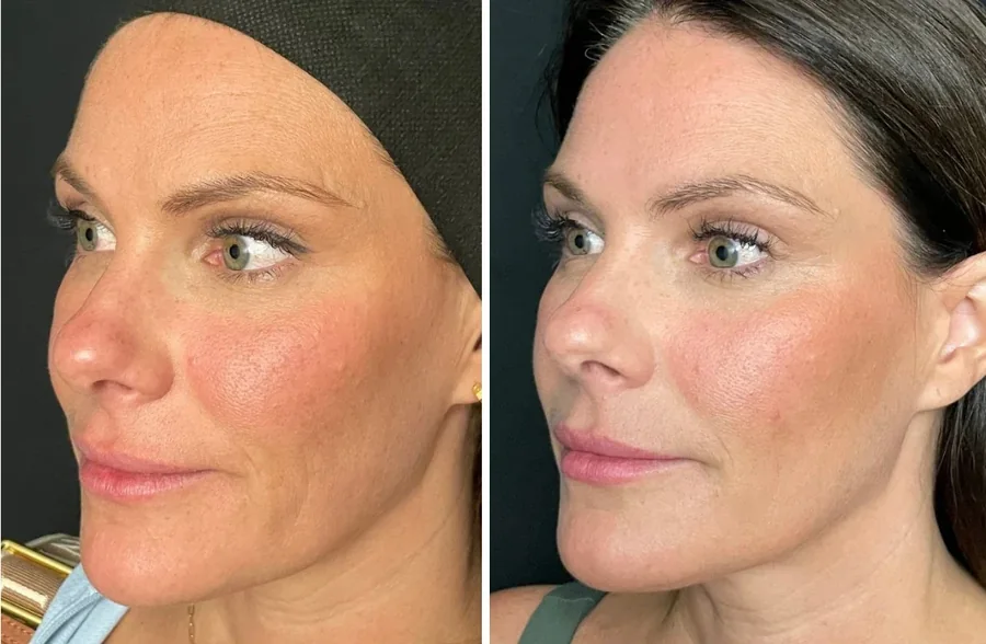 Attiva skin tightening before and after, cheek and jawline, three-quarter view, patient 3