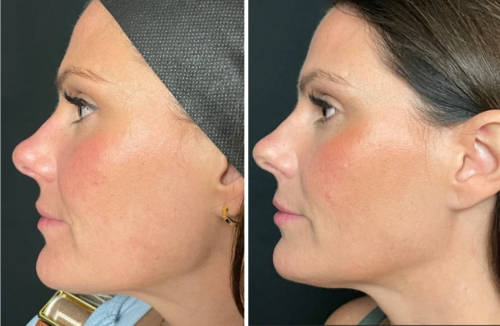 Attiva skin tightening before and after, jawline, side profile, patient 3, enlarged