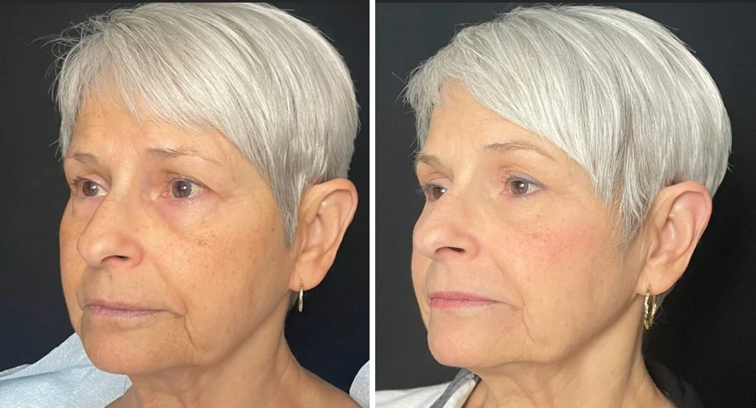 Attiva skin tightening before and after, lower face, left three-quarter view, patient 5, enlarged