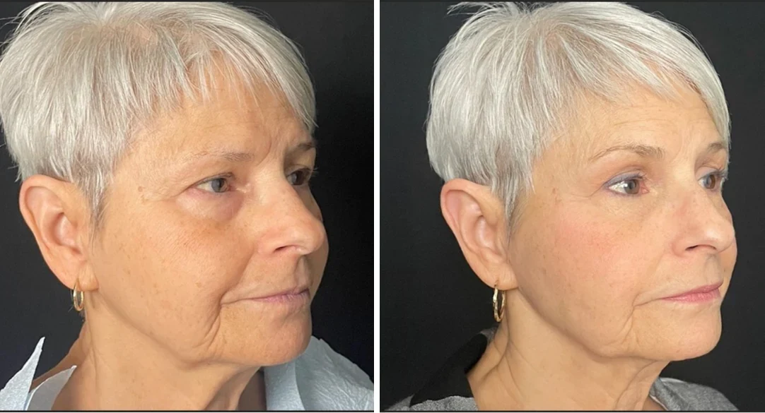 Attiva skin tightening before and after, jawline, right three-quarter view, patient 5, enlarged